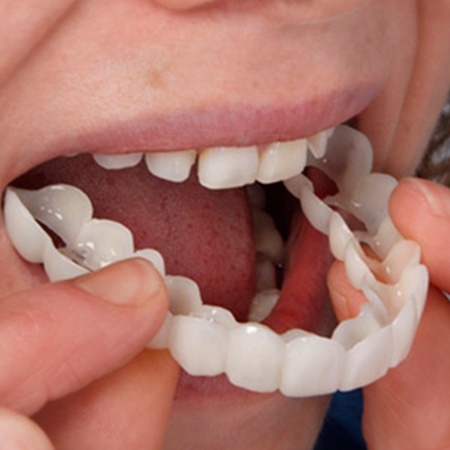 نظرات در مورد لمینت متحرک دندان